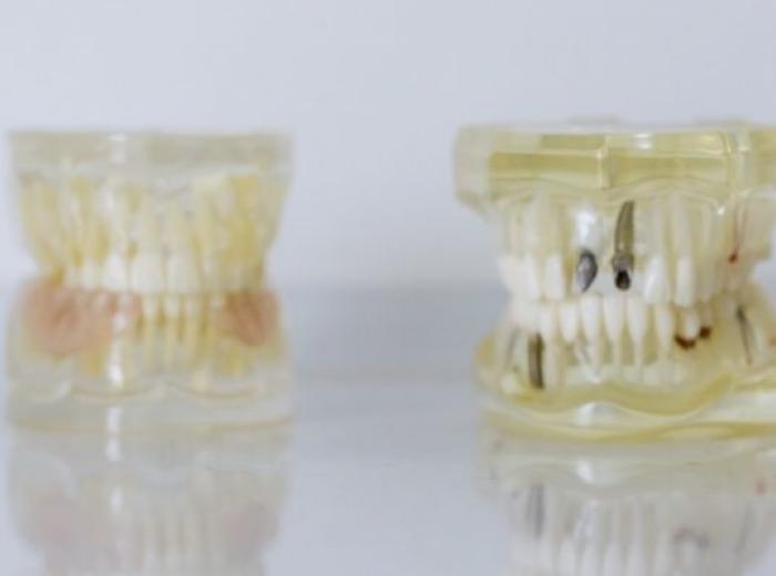 Removable Partial Dentures