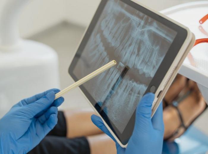 Are Dental X-Rays Really Necessary?