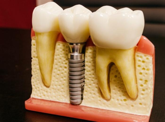 Options for Missing Teeth