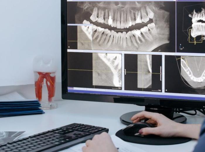 Don’t Delay with Impacted Wisdom Teeth