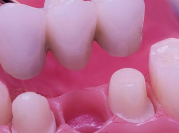 Dental Bridge vs. Implant: Which One Should I Get?