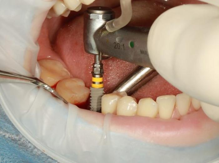 What are Dental Implants?