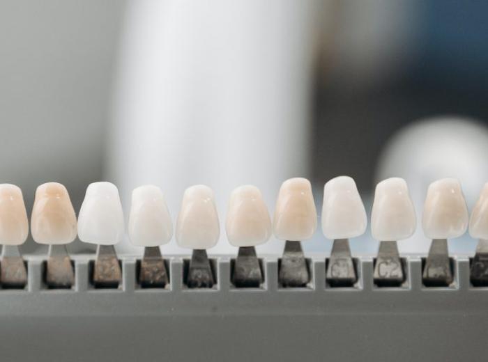 Veneers vs. Composite Bonding