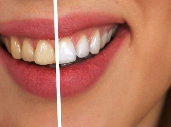 Avoid Side Effects: The Top Teeth Whitening Mistakes