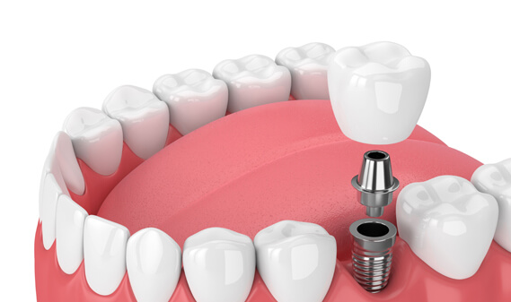 Maintaining And Caring For Your New Implants