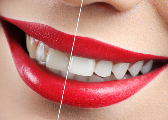 Most Restorations Cannot Be Whitened