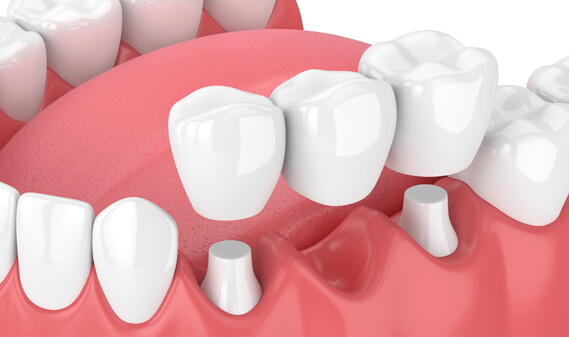 What Are Dental Bridges