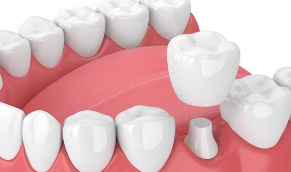 What Are Dental Crowns