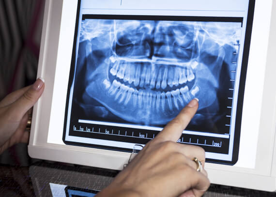 What Are Dental X Rays
