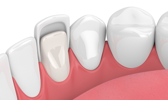 What Are Porcelain Veneers