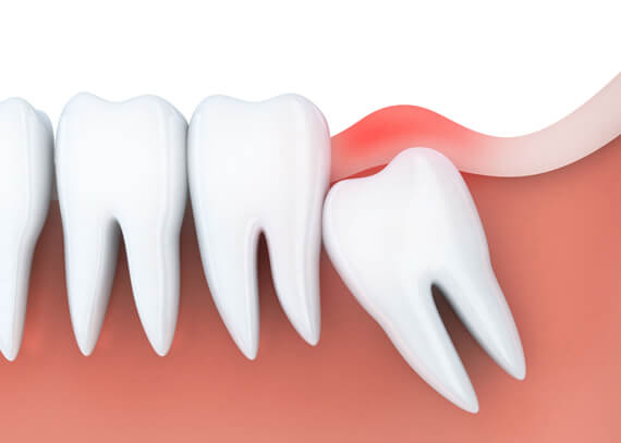 What Is Wisdom Teeth Removal