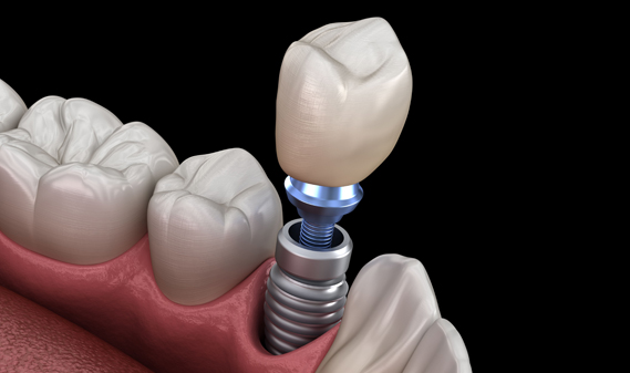 Who Is A Candidate For Dental Implants