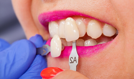 Who Is A Candidate For Porcelain Veneers