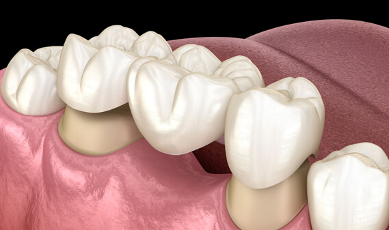 Why Are Dental Bridges Needed