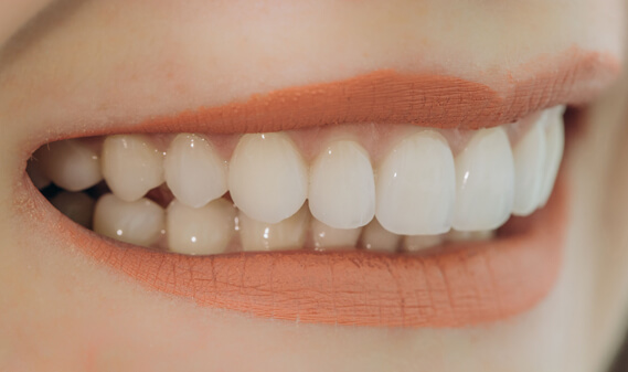 Why Are Dental Veneers Needed