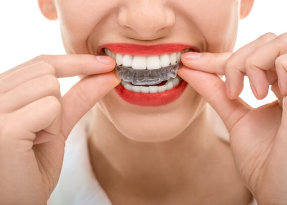 Why Are Mouth Guards Needed