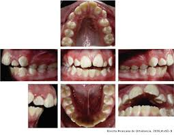 Bite Correction And Molar Relationship