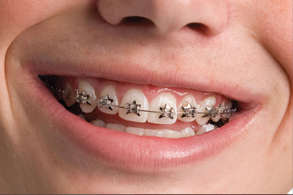 Phases Of Orthodontic Treatment