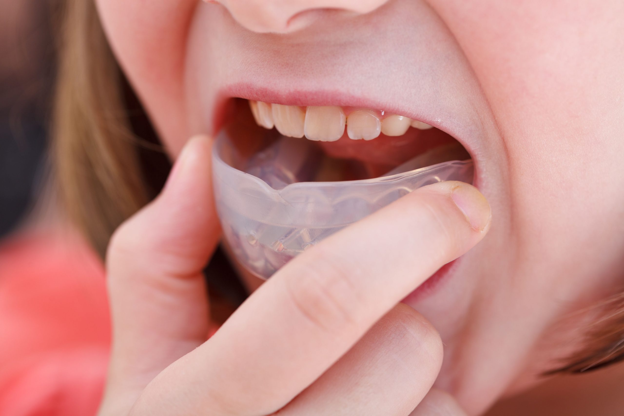 What is the Best Way to Clean a Mouthguard? Definitive Dental