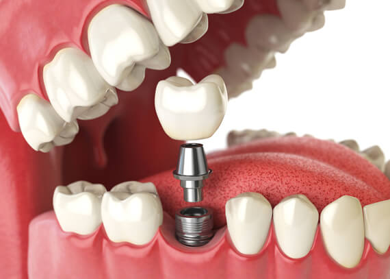 dental implants