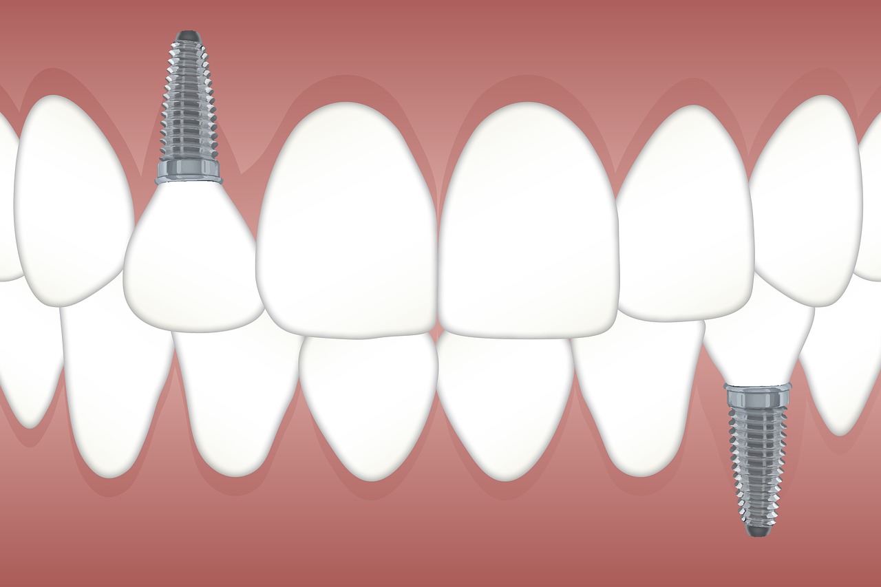 illustration of two dental implants