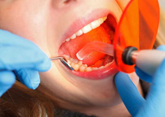 dental bonding patient