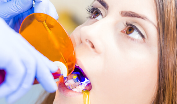 dental bonding procedure