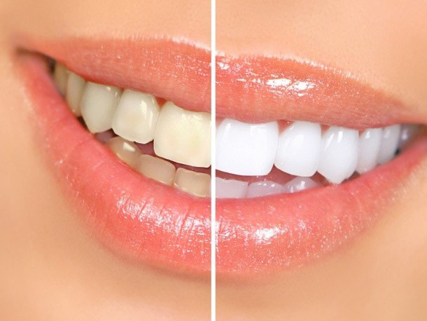 teeth whitening procedure