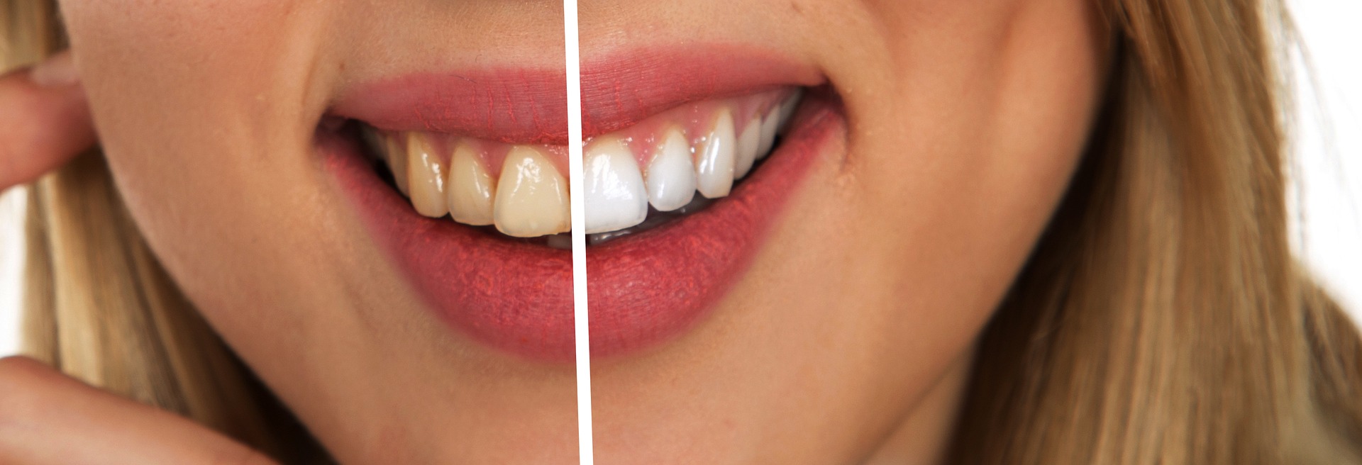 Before and after photos of whitened teeth