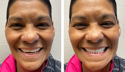 women smile after dental surgery