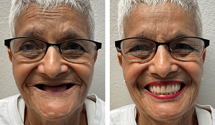 sj implant dentures treatment before after