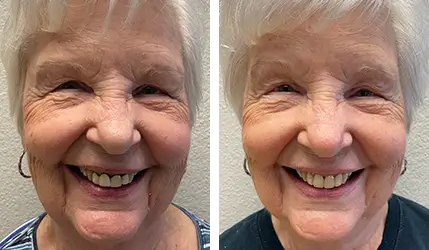 sj implant dentures treatment before after
