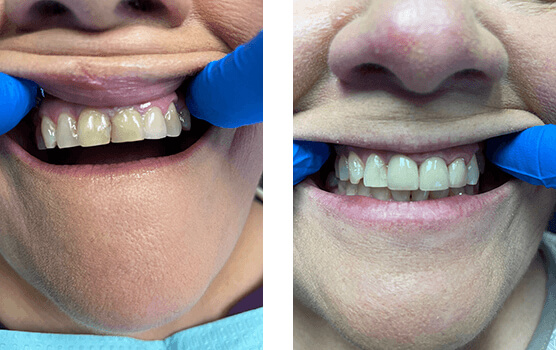 Christy's veneers treatment before and after