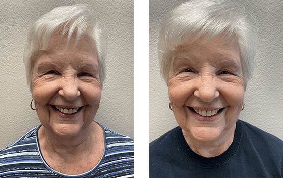 ruth front tooth treatment before after