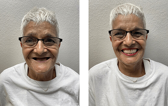 sj implant dentures treatment before after