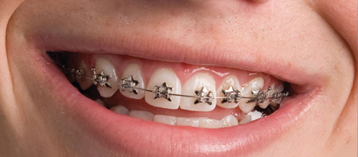 Phases of Orthodontic Treatment - Definitive Dental