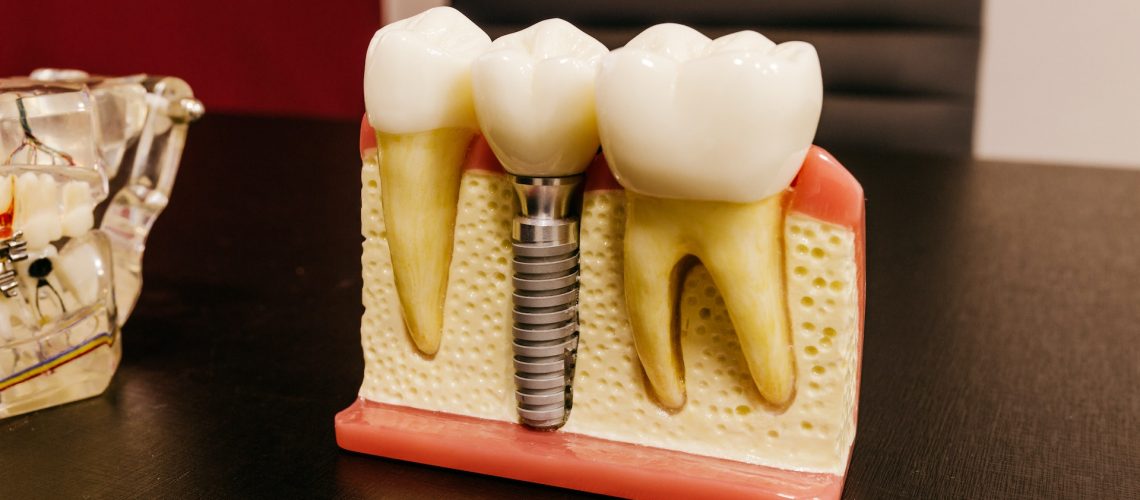 Close up of a dental implant