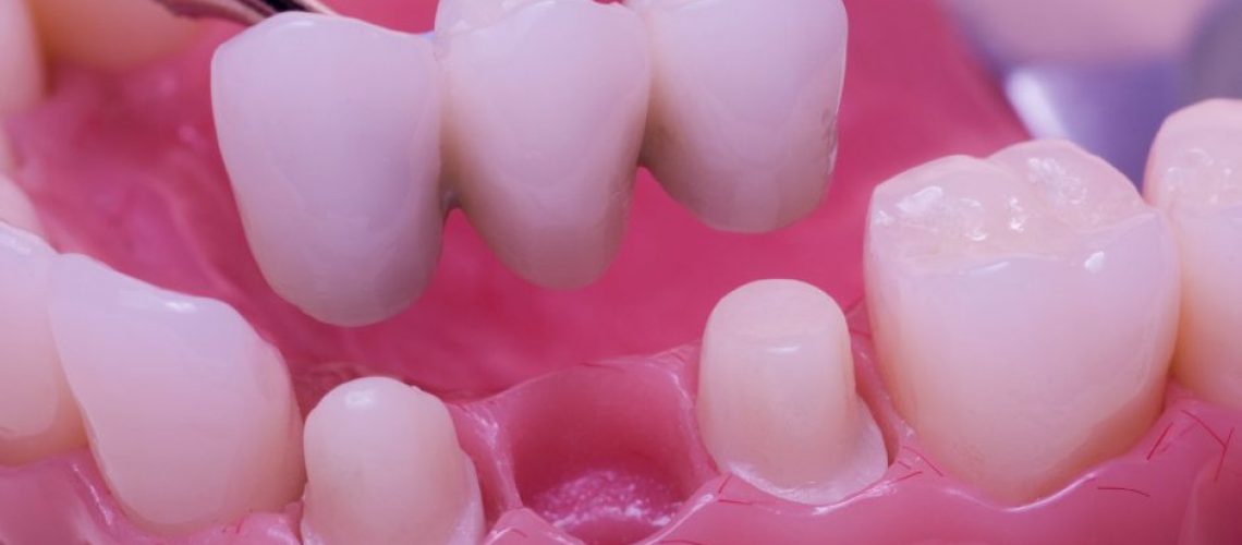 dental bridges