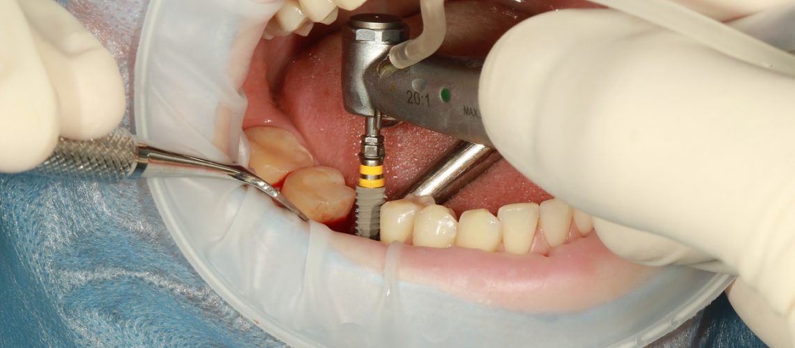 patient undergoing dental implant surgery