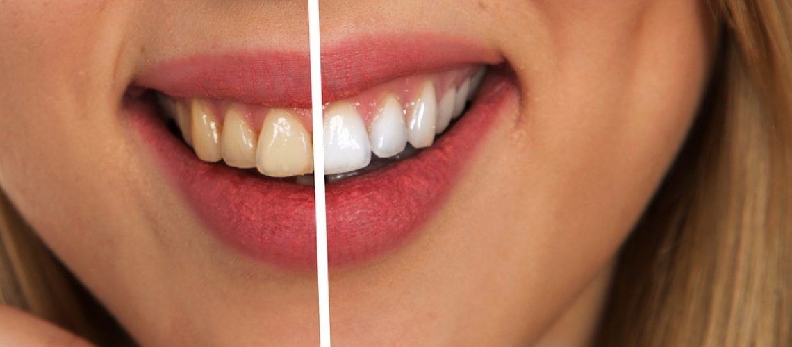 Before and after teeth whitening