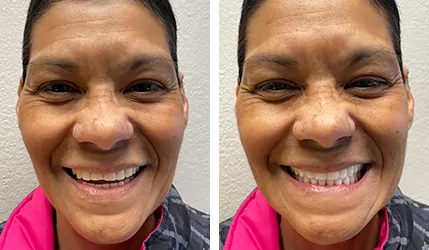 women smile after dental surgery