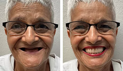 sj implant dentures treatment before after